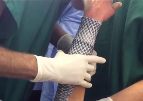 SUS poderá incorporar pele de tilápia para tratamento de queimados