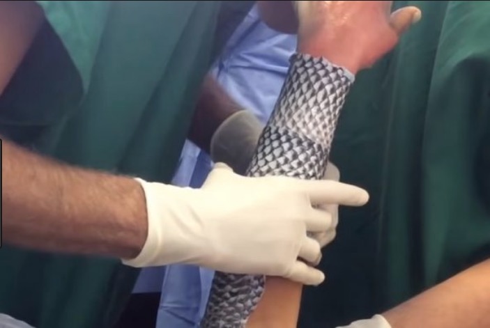 SUS poderá incorporar pele de tilápia para tratamento de queimados