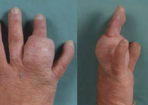 Mulher sofre com inchaço no dedo após usar anel; Entenda 