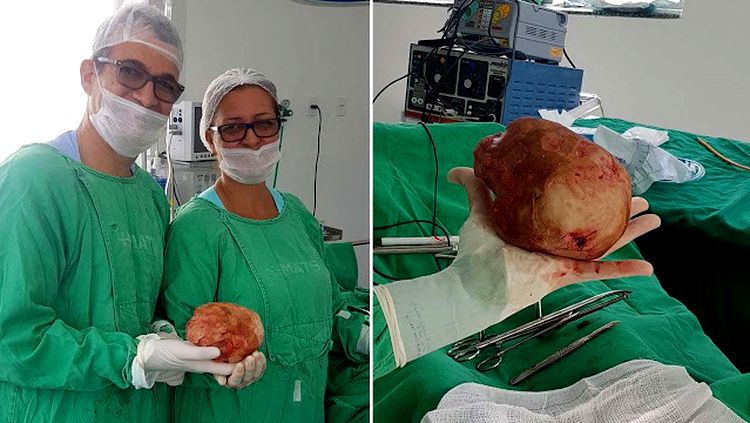 Lavrador tem pedra de 1,3 Kg e 18 cm retirada da bexiga 