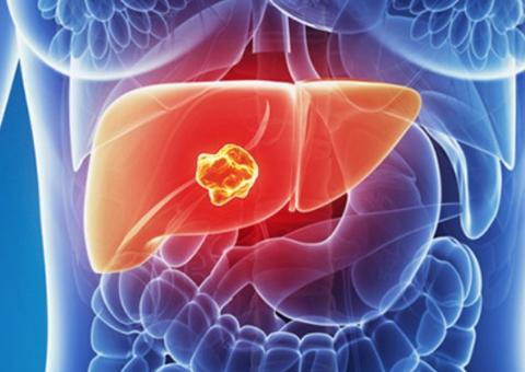 Câncer no fígado: Saiba mais sobre a técnica de quimioembolização hepática