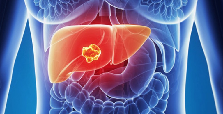 Câncer no fígado: Saiba mais sobre a técnica de quimioembolização hepática