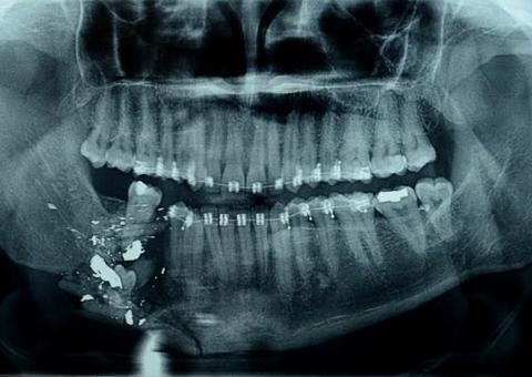 Hospital Adriano Jorge realiza cirurgia inédita de reconstrução de mandíbula no Amazonas