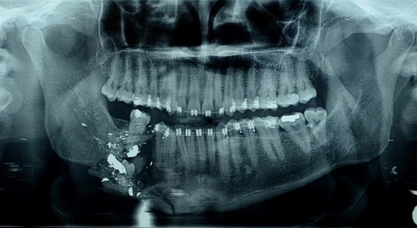 Hospital Adriano Jorge realiza cirurgia inédita de reconstrução de mandíbula no Amazonas