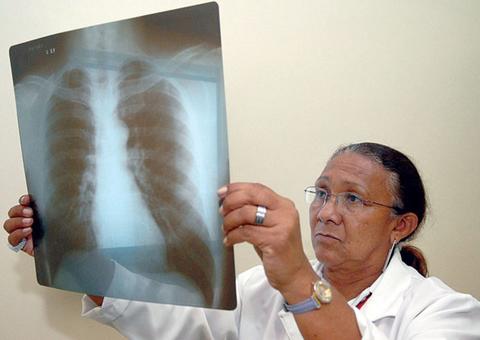 Amazonas terá novo e mais eficaz teste rápido para tuberculose