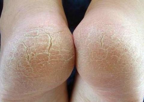 Saiba como acabar de vez com o ressecamento e rachaduras dos pés 