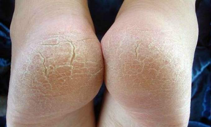 Saiba como acabar de vez com o ressecamento e rachaduras dos pés 