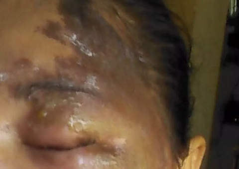 Cinco pessoas são atacadas por homem misterioso com líquido semelhante a ácido 