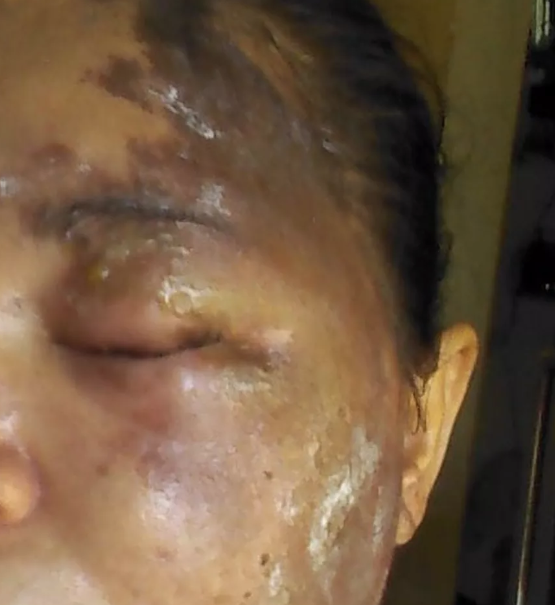 Cinco pessoas são atacadas por homem misterioso com líquido semelhante a ácido 