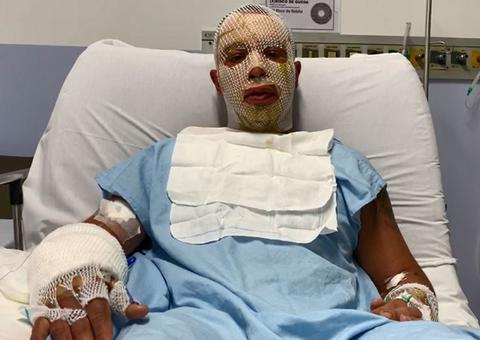 Prefeito e esposa feridos na explosão de fogueira por pouco não ficaram cegos