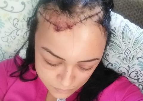 Mulher leva 40 pontos na cabeça após ter carro atingido por estaca arremessada por homem
