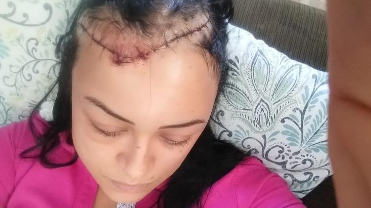 Mulher leva 40 pontos na cabeça após ter carro atingido por estaca arremessada por homem