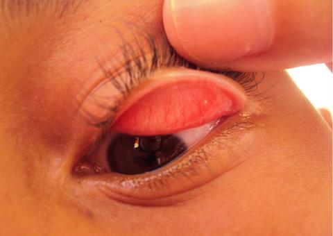 Fiocruz realiza estudo em municípios do Amazonas para eliminação do tracoma