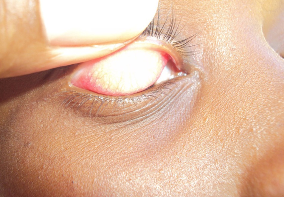 Fiocruz realiza estudo em municípios do Amazonas para eliminação do tracoma