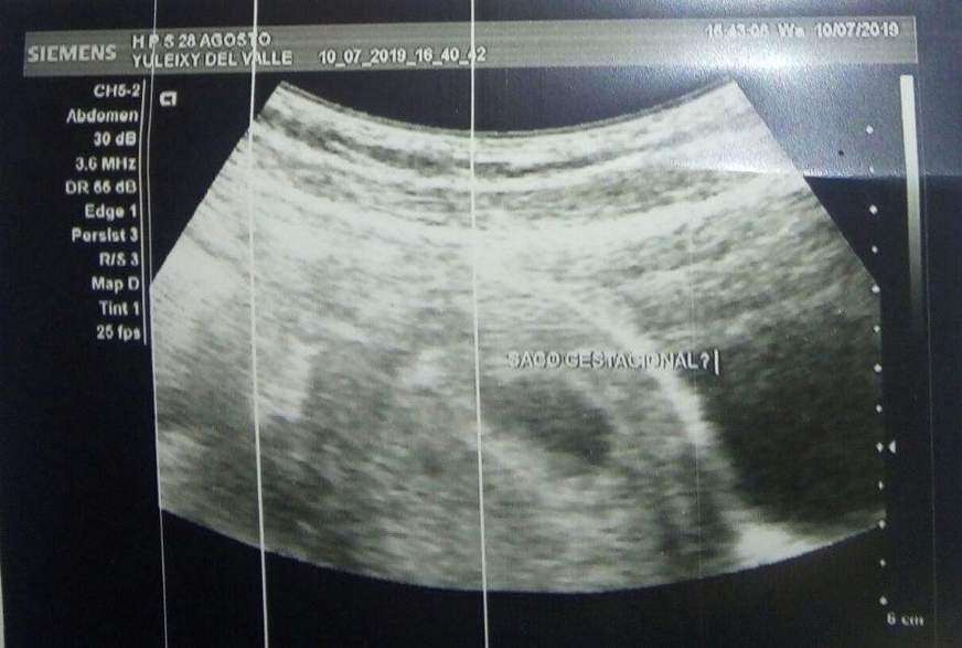 Venezuelana que acusa padre de estupro em Manaus está grávida