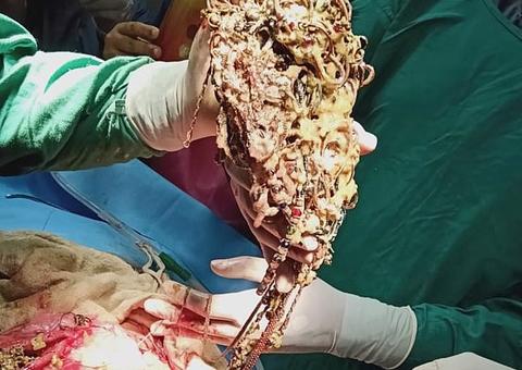 Médicos ficam chocados ao encontrarem 220 joias e moedas no estômago de mulher