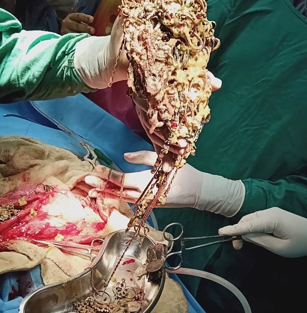 Médicos ficam chocados ao encontrarem 220 joias e moedas no estômago de mulher