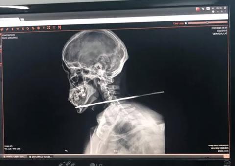 Homem é flechado no pescoço ao sair de festa