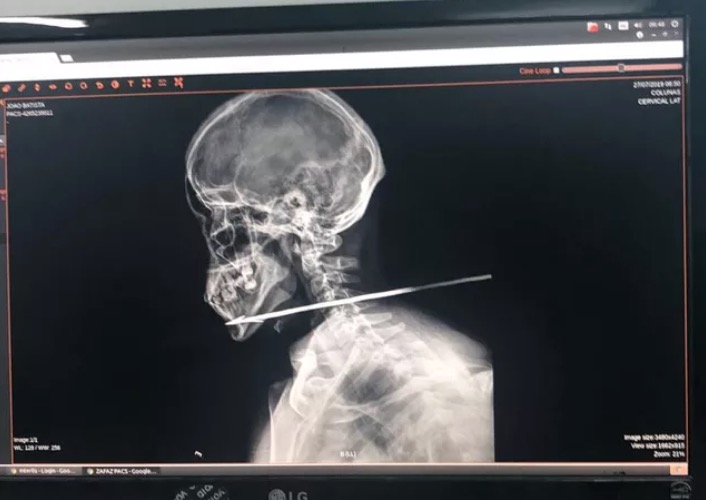 Homem é flechado no pescoço ao sair de festa