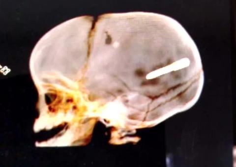 Bebê é internado em estado grave ao ser atingido com prego na cabeça