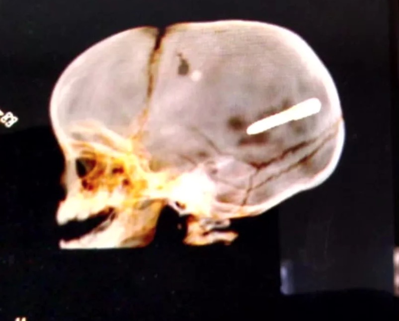 Bebê é internado em estado grave ao ser atingido com prego na cabeça