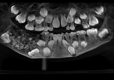 Dentistas encontram 526 dentes na boca de menino de 7 anos 