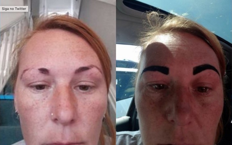 Mulher fica com sobrancelha de ‘Angry Birds’ após procedimento dar errado