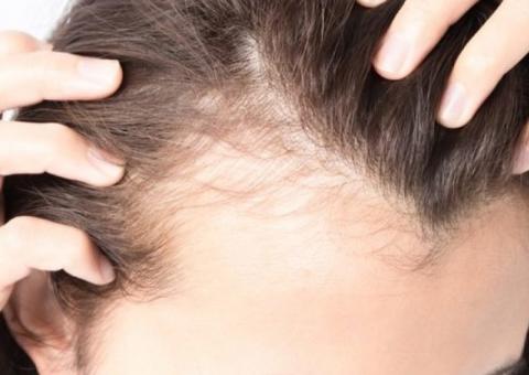 Especialista esclarece o que você precisa saber sobre a calvície feminina