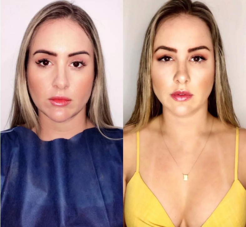 Ex-bbb Patrícia Leitte mostra antes e depois de harmonização facial