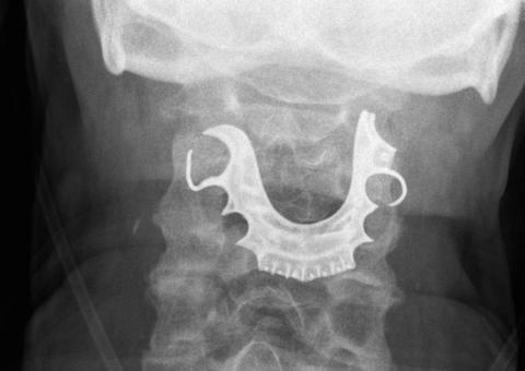 Dentadura é achada na garganta de homem uma semana após cirurgia