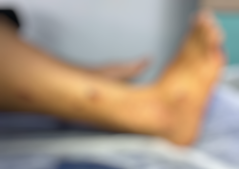 Jovem fica ferido após explosão de bomba de catolé durante jogo entre Manaus x Brusque 