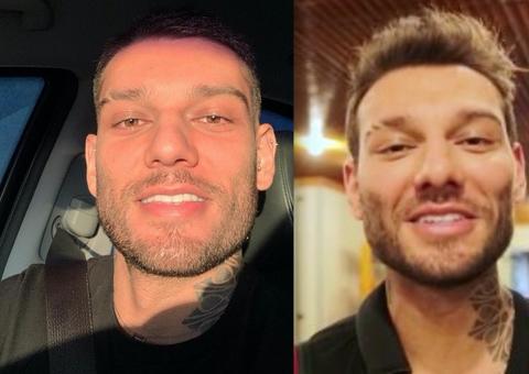 Lucas Lucco aparece com rosto diferente e é criticado por suposta harmonização facial