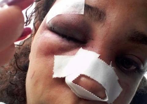 Com ciúme, homem quebra nariz de ex-mulher na frente da filha de 2 anos