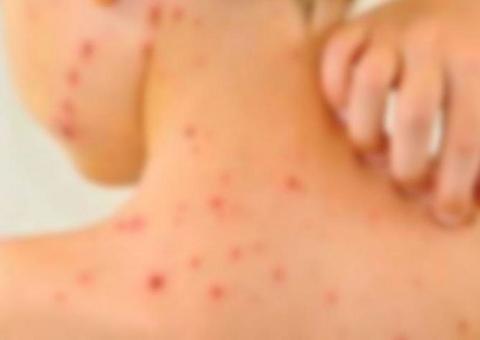 Sarampo: entenda os sintomas, riscos e tratamento