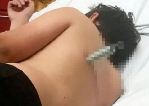 Menino de 12 sofre acidente em trampolim e fica com mola alojada nas costas