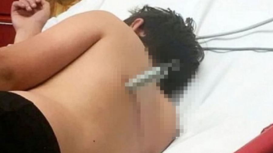 Menino de 12 sofre acidente em trampolim e fica com mola alojada nas costas