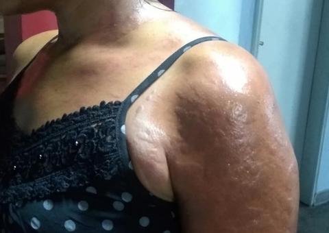 Em Manaus, marido é preso após jogar óleo quente na própria esposa durante discussão