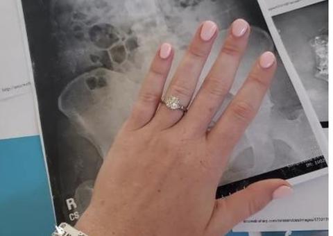 Mulher engole anel de noivado ao sonhar que estava fazendo a mesma coisa