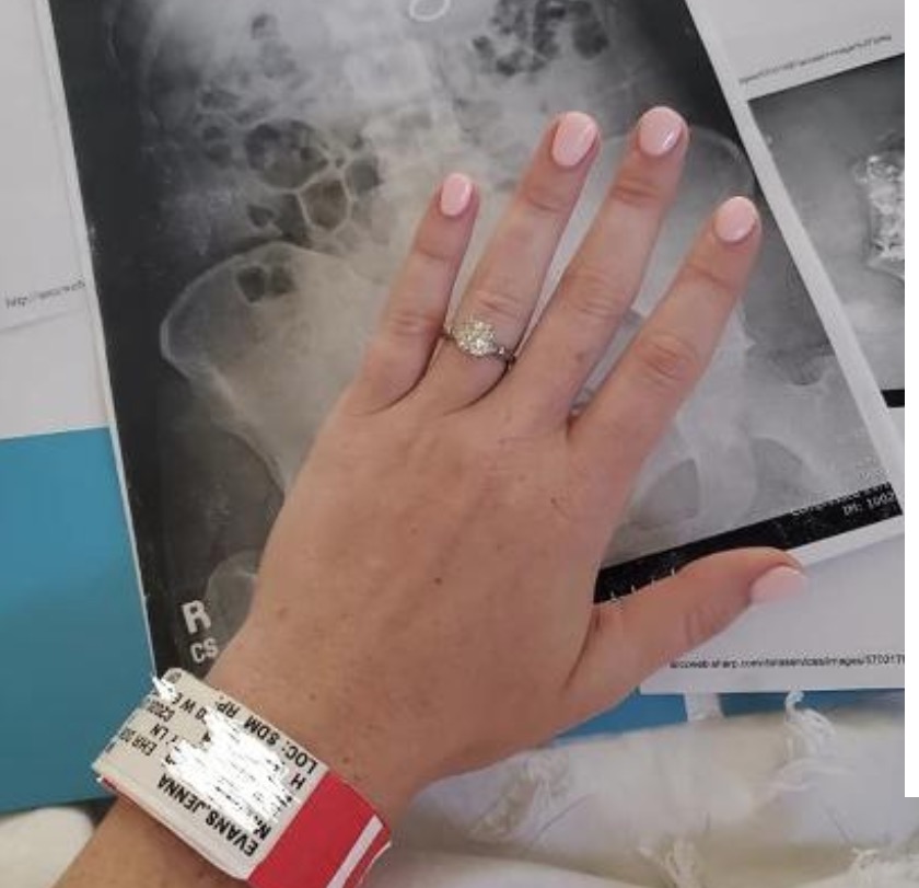 Mulher engole anel de noivado ao sonhar que estava fazendo a mesma coisa