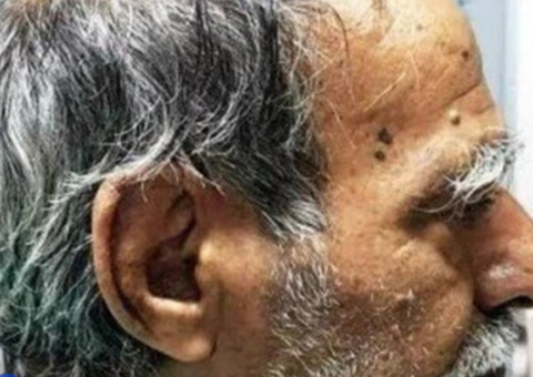 Homem tem 'chifre' de 10 centímetros retirado da cabeça; Veja foto