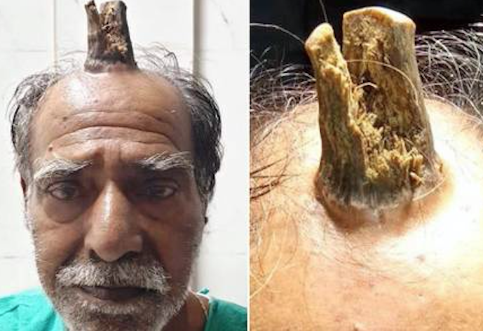 Homem tem 'chifre' de 10 centímetros retirado da cabeça; Veja foto