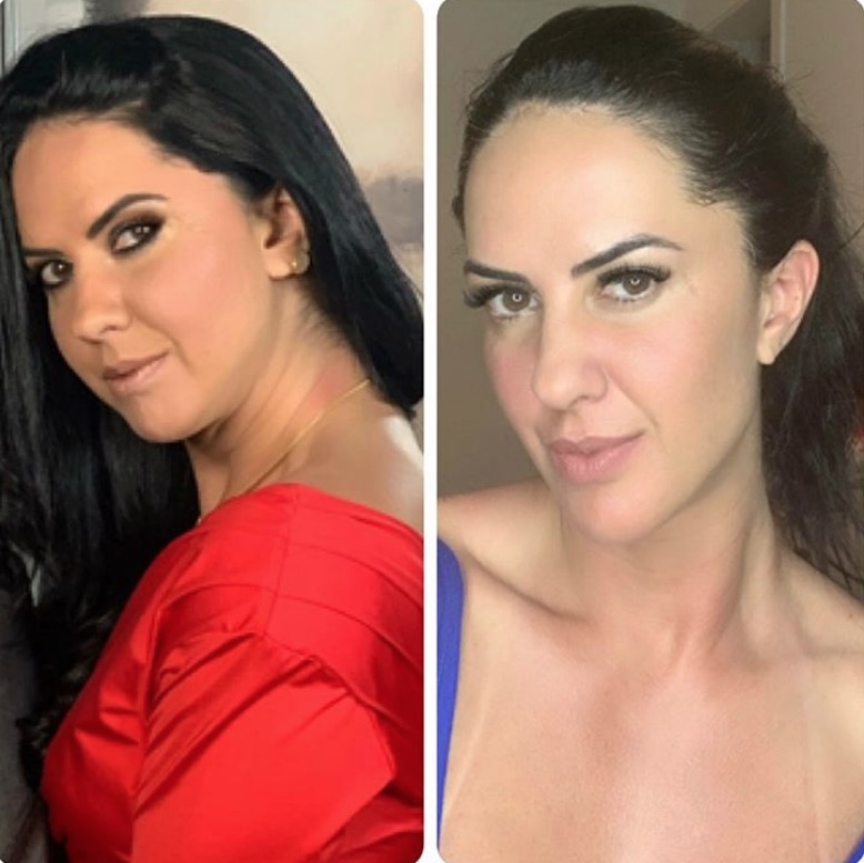 Graciele Lacerda mostra rosto diferente com dieta após congelar óvulos  
