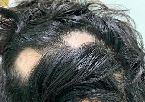 Entenda o que é Alopecia Areata, doença autoimune que provoca queda de cabelo