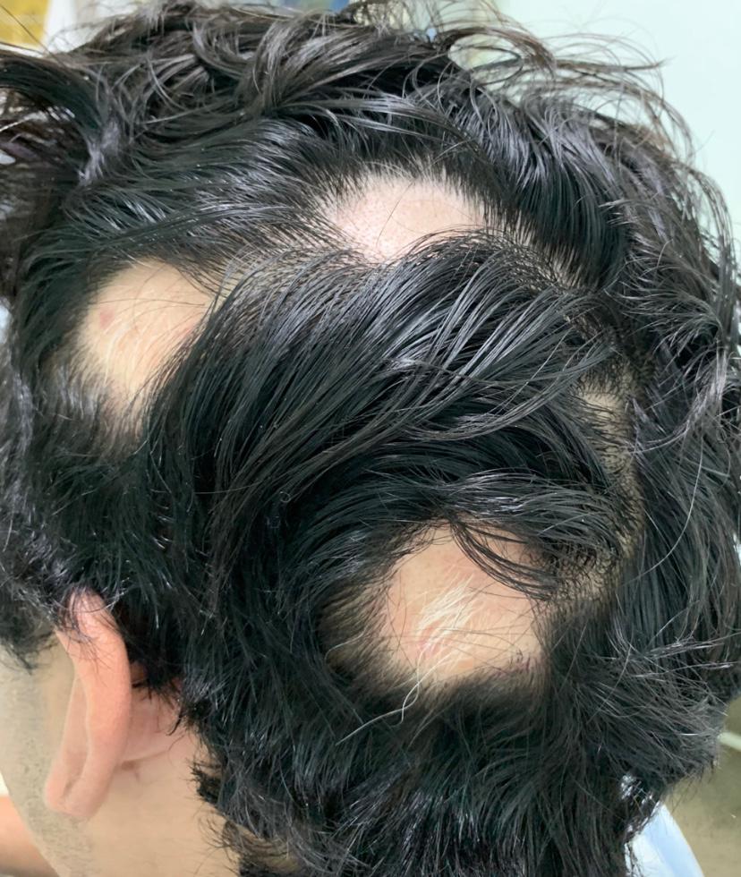 Entenda o que é Alopecia Areata, doença autoimune que provoca queda de cabelo