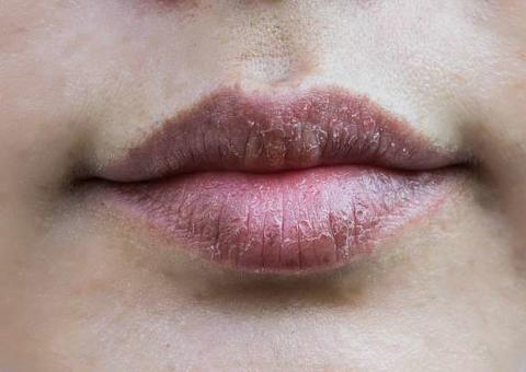 O que fazer quando a boca fica seca com frequência?