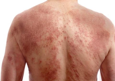 Dermatite atópica é crônica e incurável, mas pode ser controlada