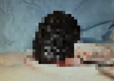 Jovem é operada para retirar quase dois quilos de cabelo do estômago