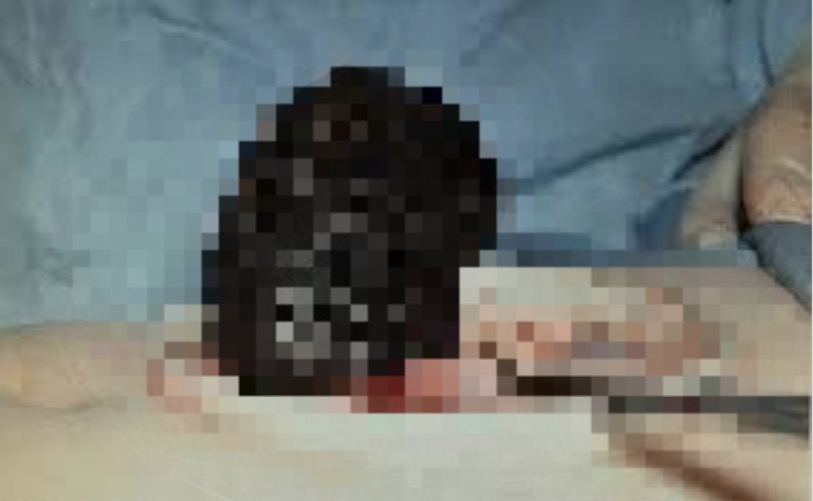 Jovem é operada para retirar quase dois quilos de cabelo do estômago