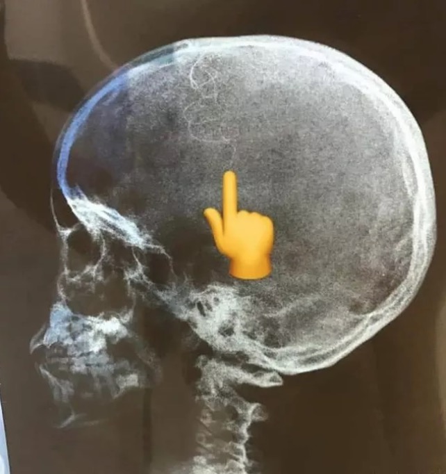 Raio-X mostra larva 'comendo' cabeça de criança de 7 anos