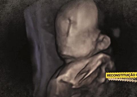 Bebê nasce sem rosto e pais denunciam negligência médica 